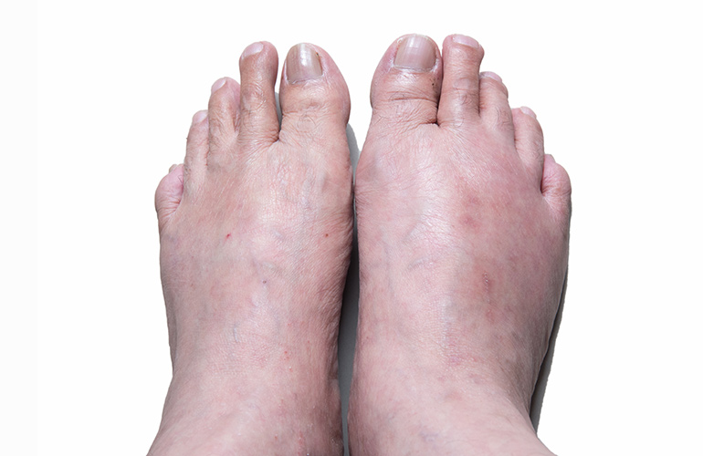 Your big toe is swollen