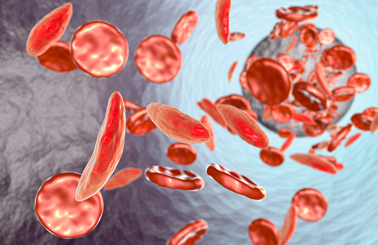 Sickle cell disease