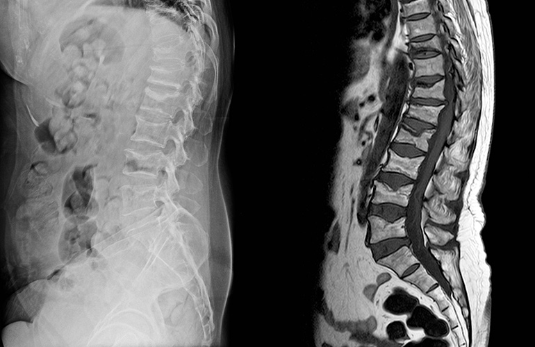You have osteoporosis