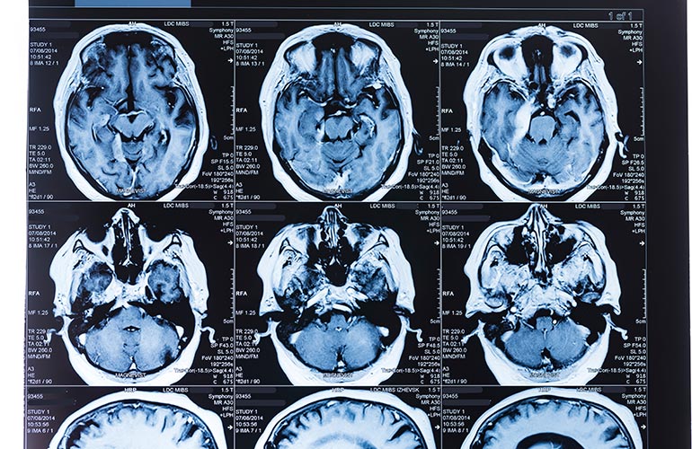 Phthalates could stunt brain growth
