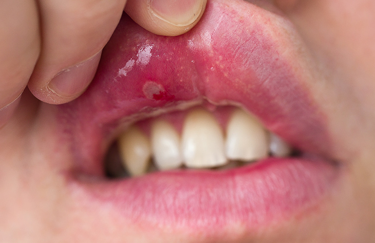 You can’t get rid of those mouth ulcers