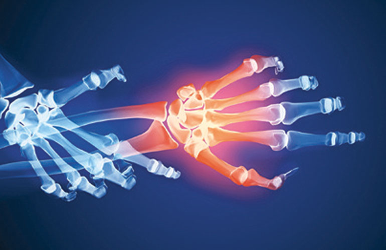 Arthritis myth 2: exercise produces joint pain