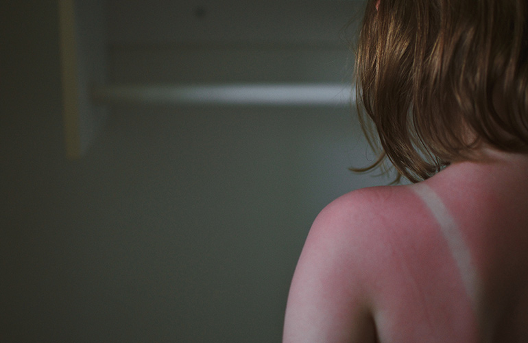 Spray away sunburn