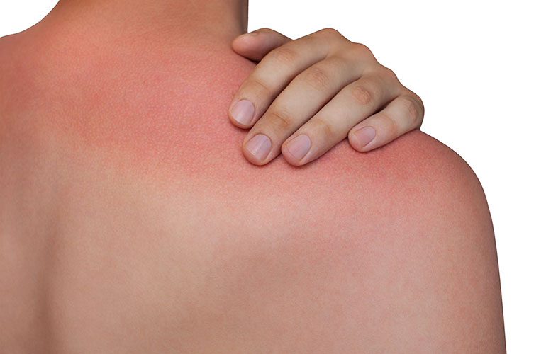 You get a rash in bright sunlight