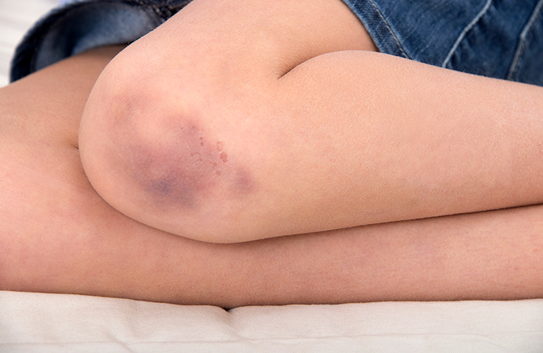 You could be at higher risk of bleeding