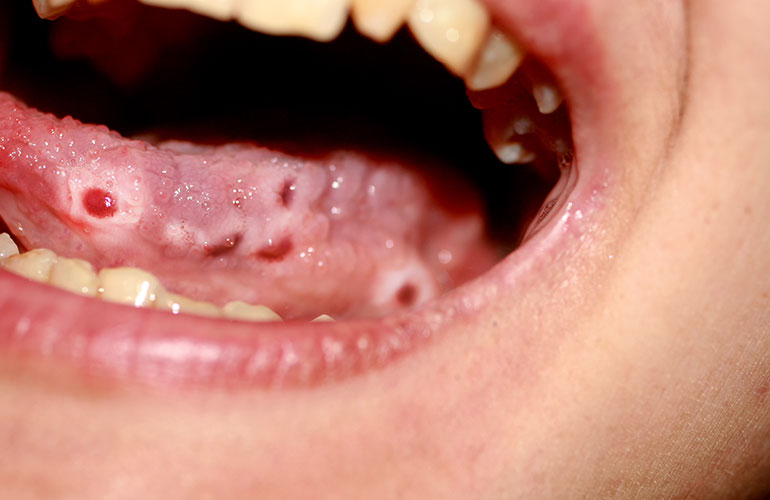 You see: persistent red lesions