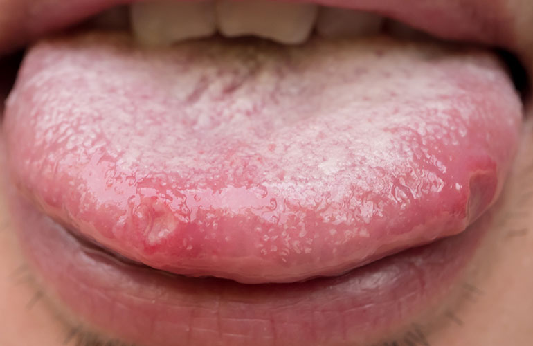 You feel: painful sores