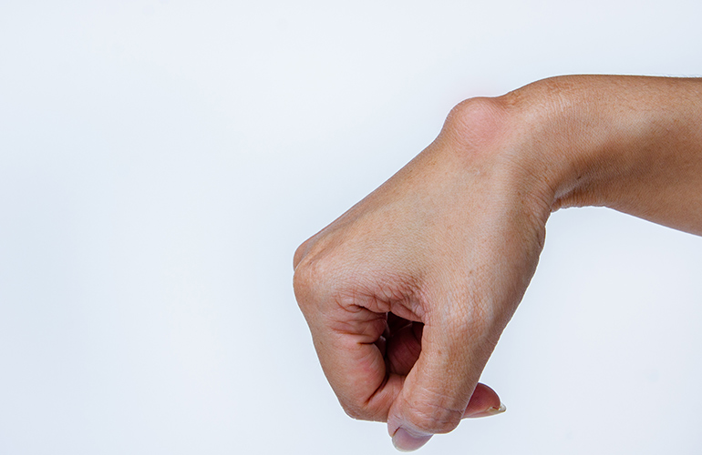 Never squeeze deep cysts