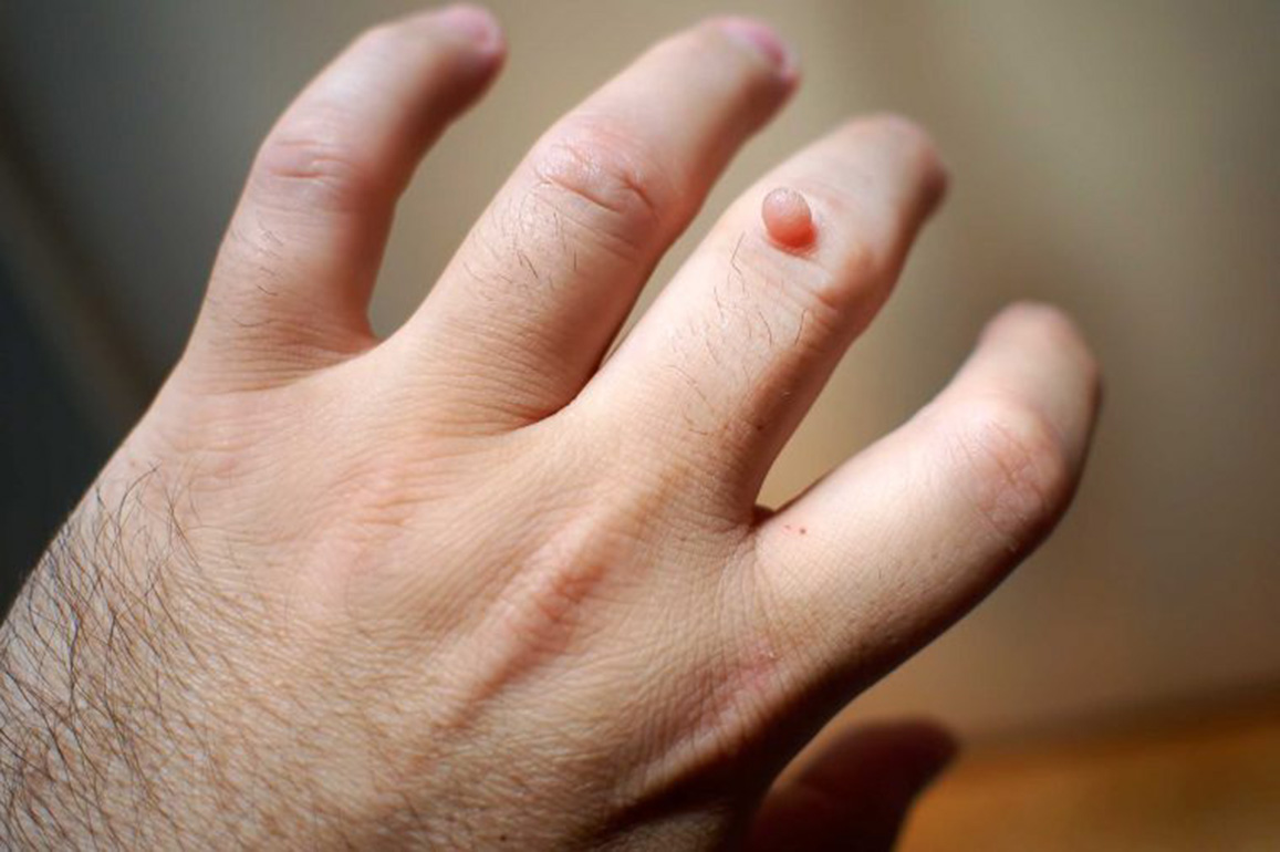 Remove warts