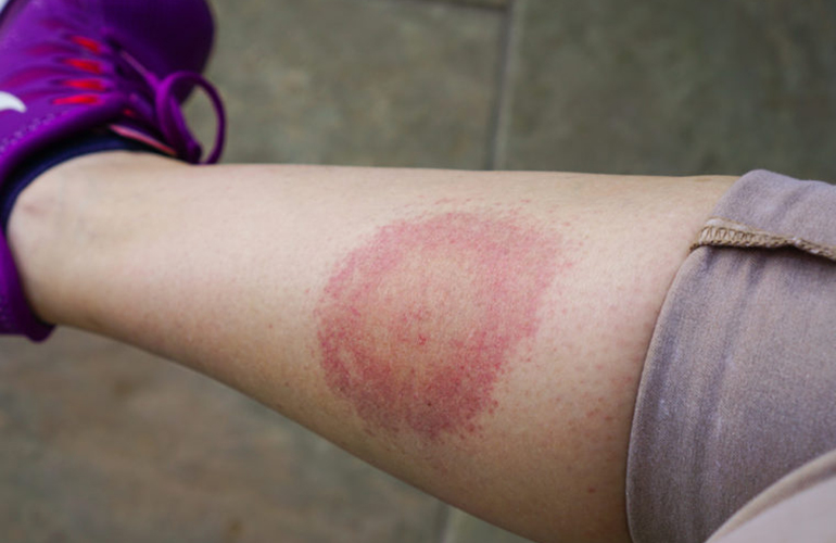True or false: If you don’t have a bulls-eye rash, you don’t have Lyme disease