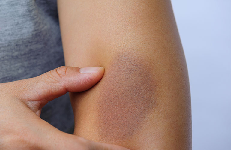 Excessive or spontaneous bruising
