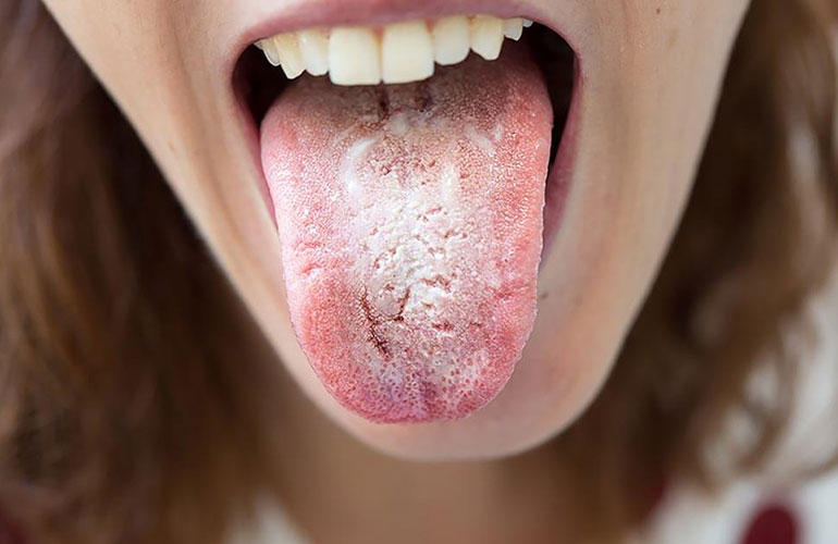 White patches in the mouth or on the tongue