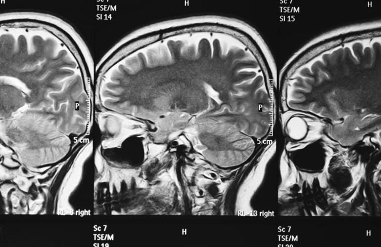 True or false: Depression is incurable
