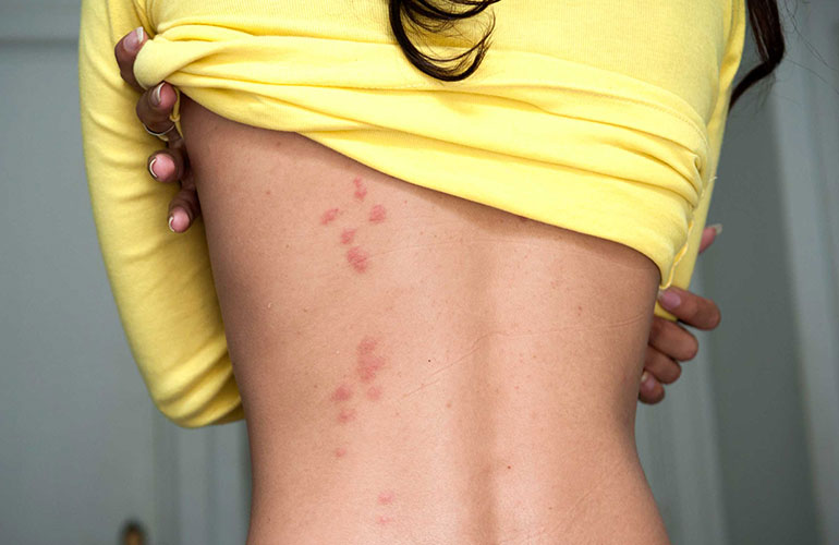 You break out in hives