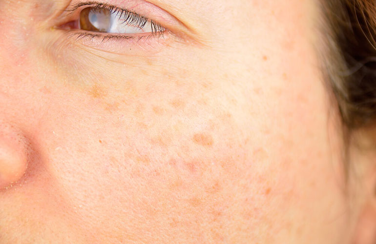 You’ve got sun spots