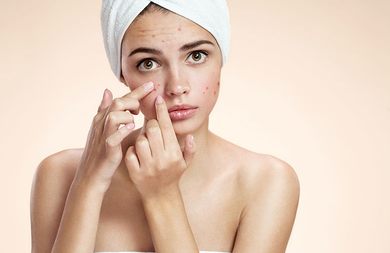 You have acne … again!