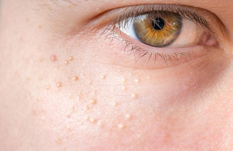 You’re getting tiny little bumps