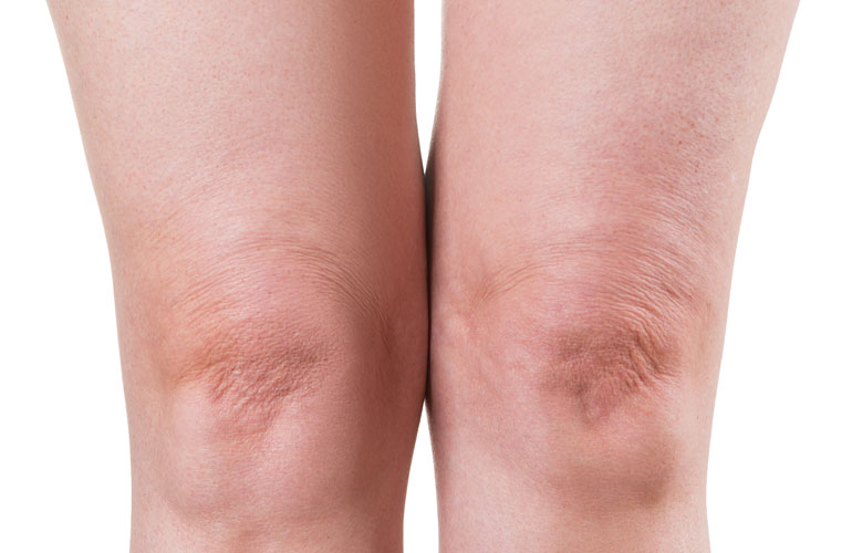 Genuphobia: Fear of knees