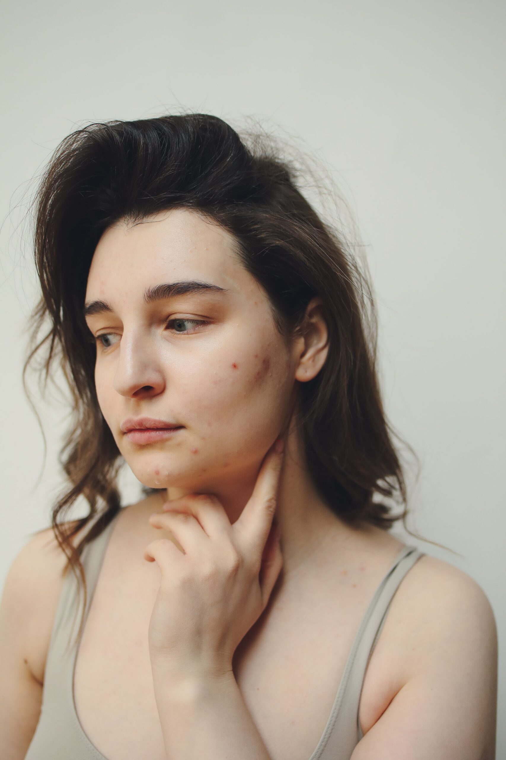 You have acne … again!