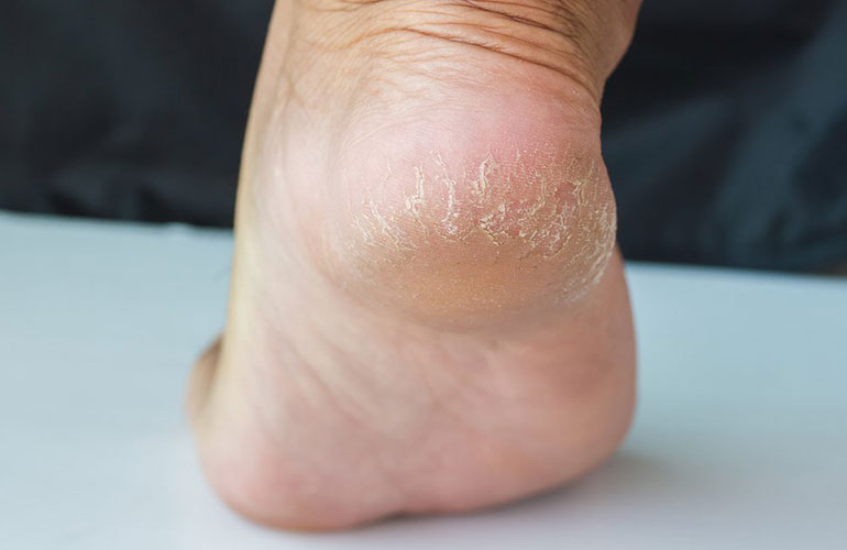 Cracked heels are common