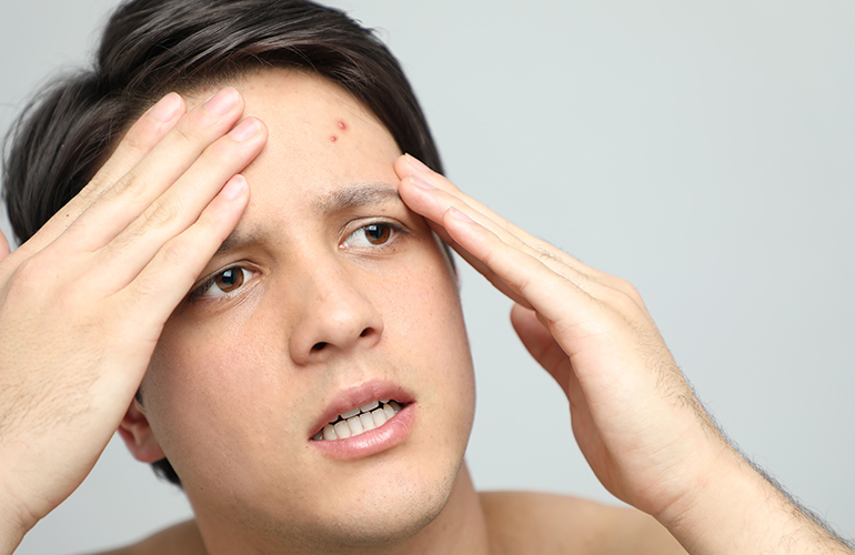 You're popping your pimples