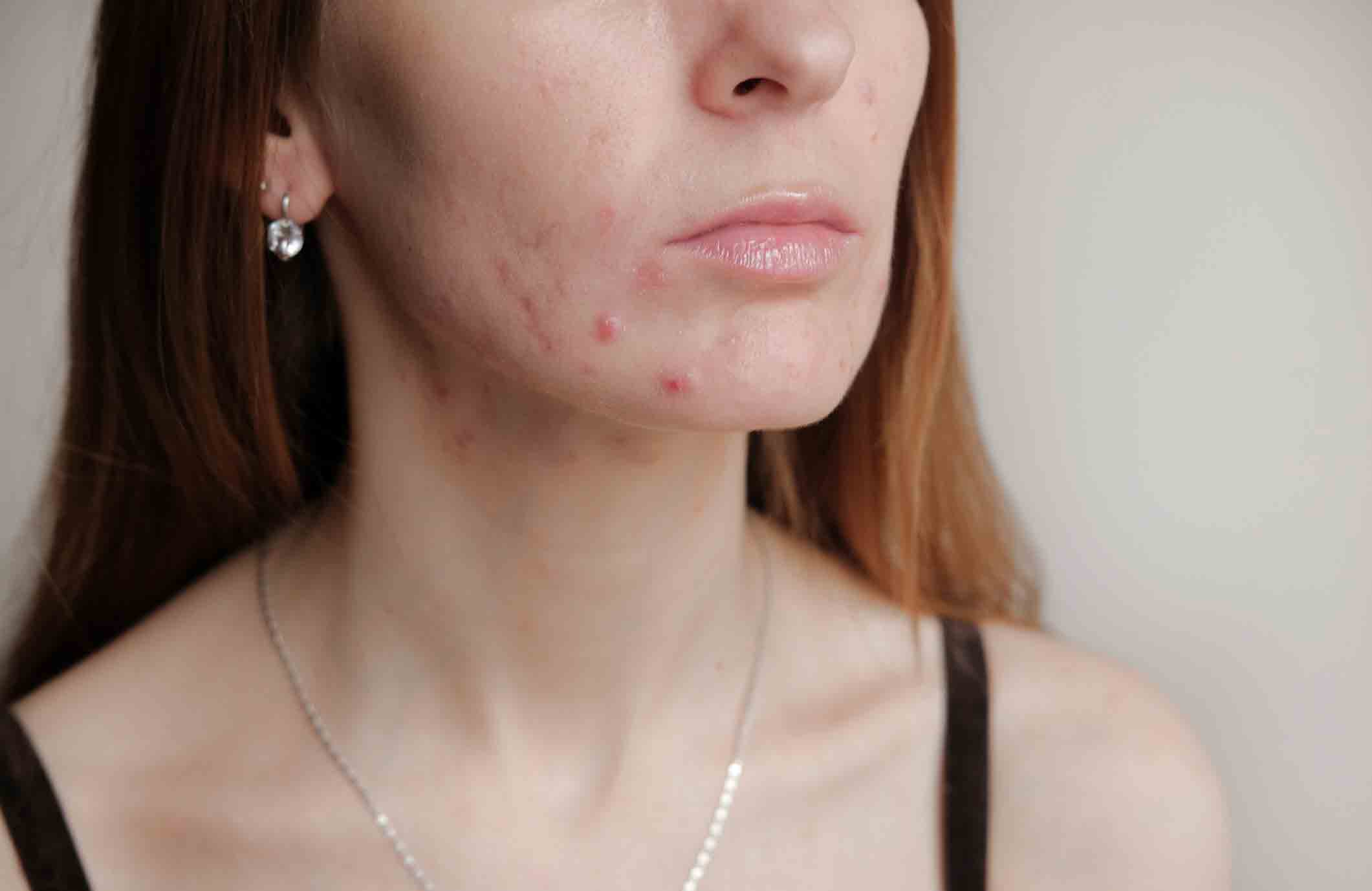 Adults get acne too