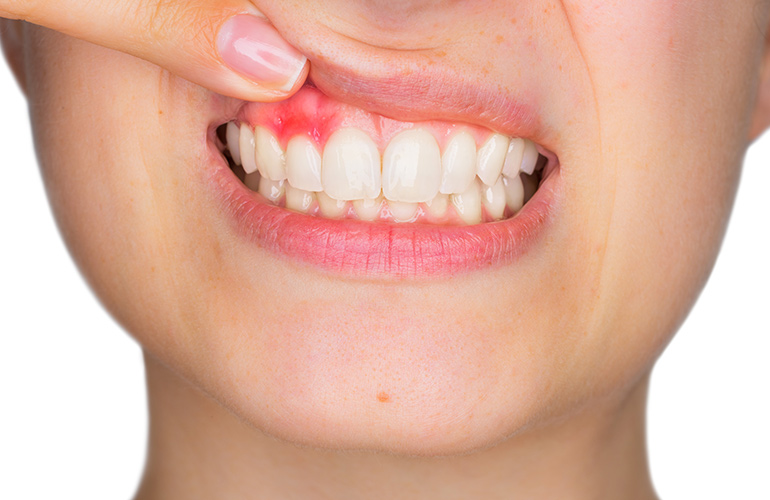 Your gums are red, inflamed, or bleeding