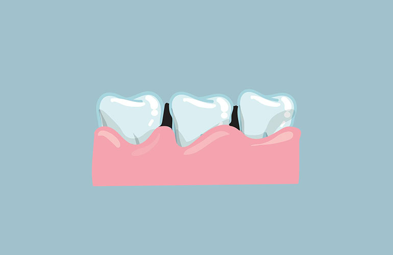 Gum recession