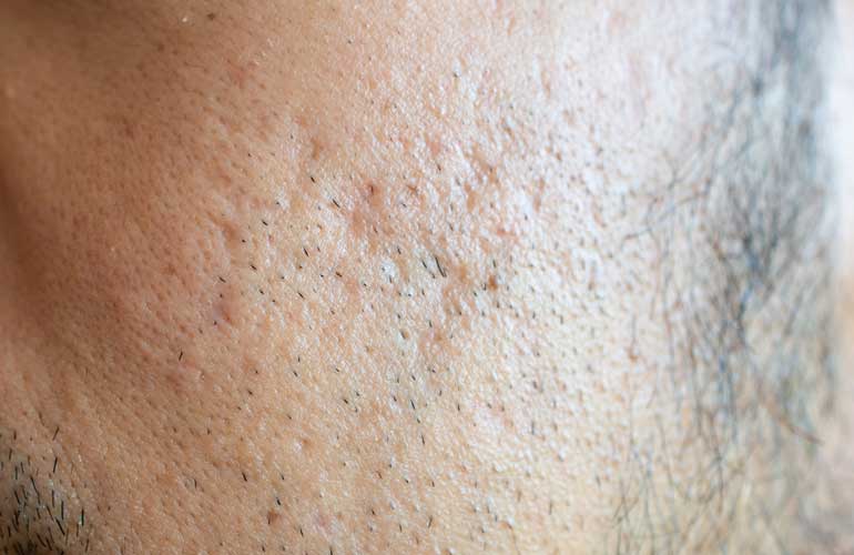 You’re obsessed with clearing your pores
