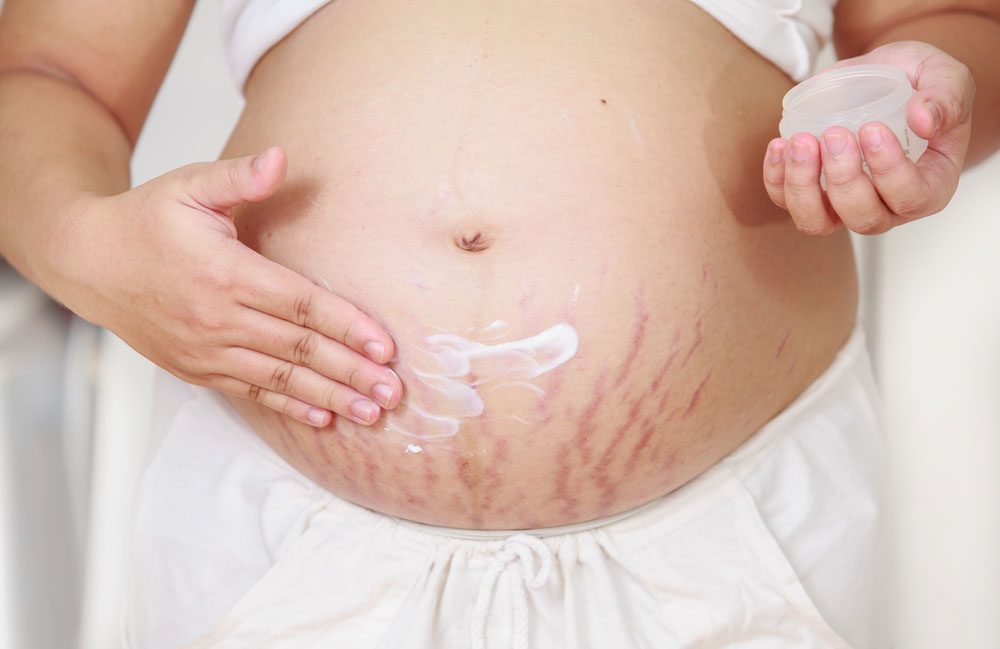 Stretch mark creams