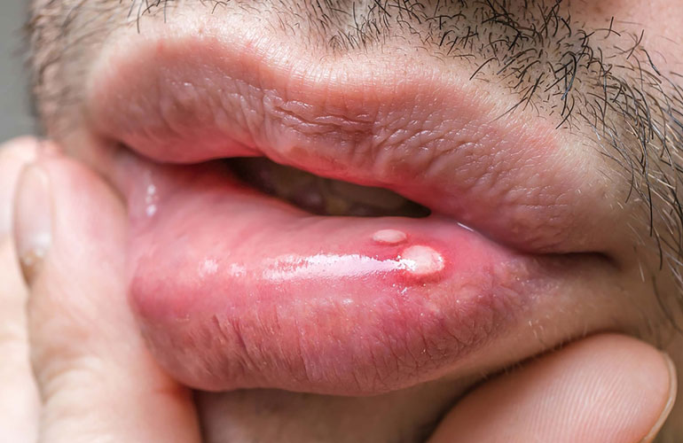 Sores or pain in your mouth