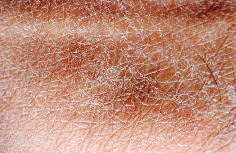 Your skin is super dry