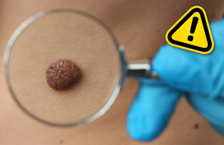 Attempting to remove a mole at home