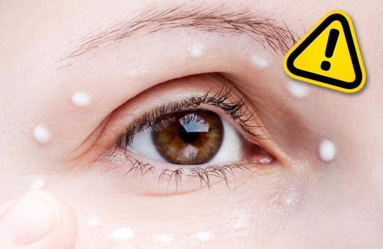 Applying haemorrhoid cream to puffy eyes