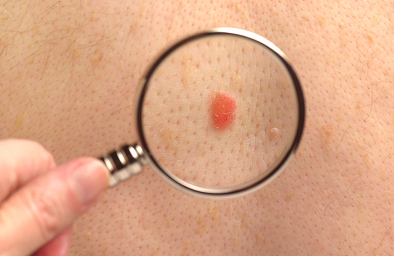 What are cherry angiomas?