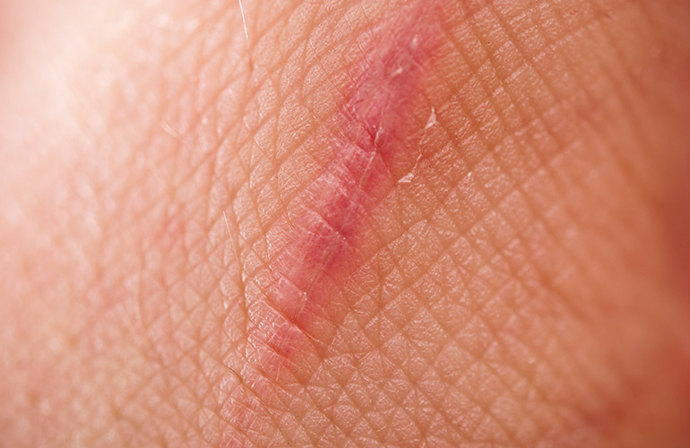 Can I remove them myself?