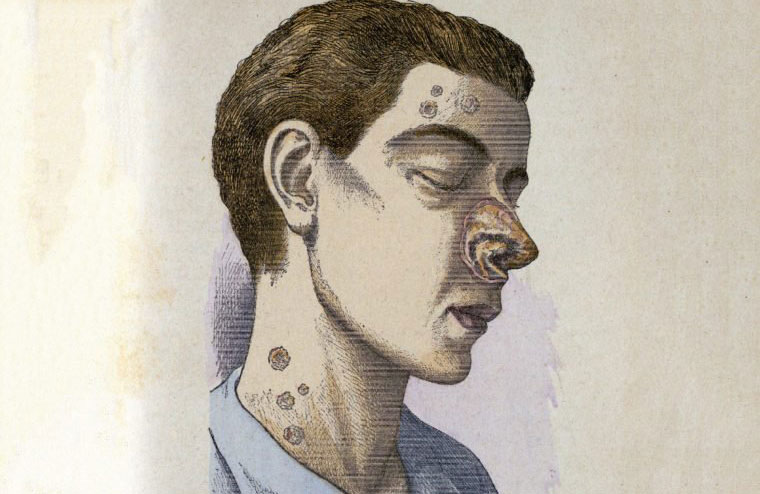 In 1494, Europe experienced the closest thing to a real-life zombie outbreak