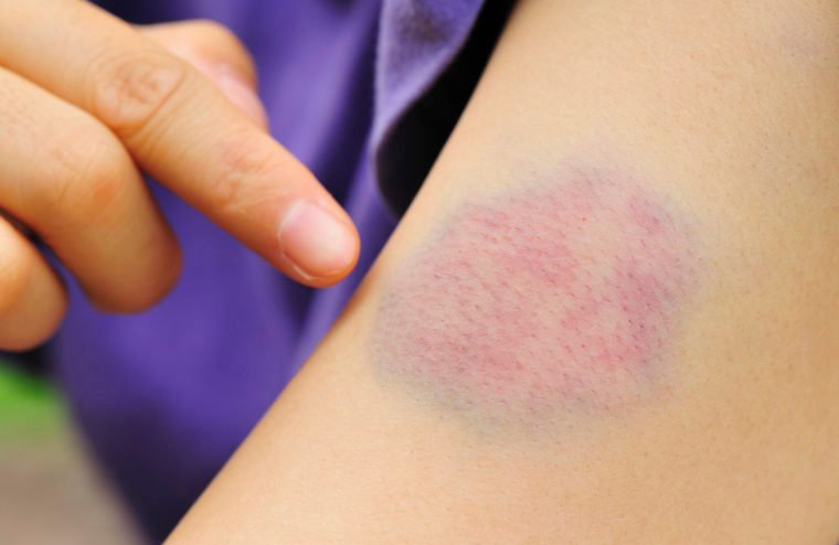 Unexpected bruises