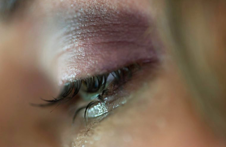 Dry eyes