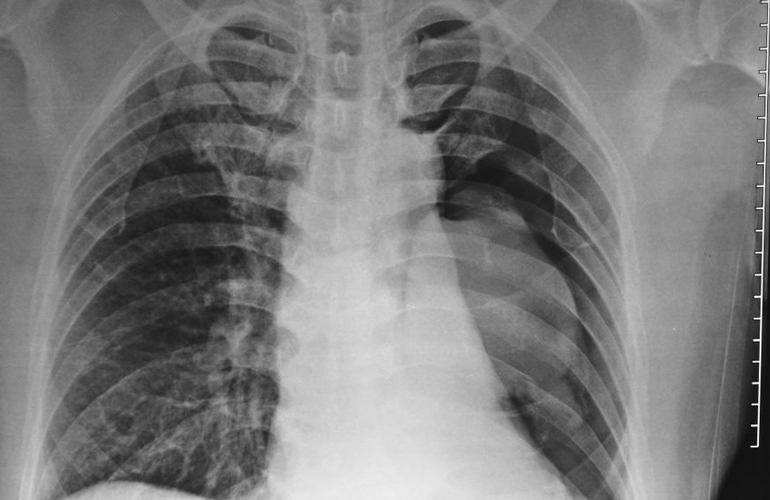 After nine months: Your lungs can fight infections again
