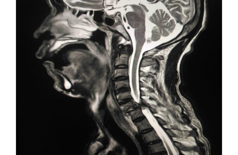 After five years: Stroke risk is significantly lower
