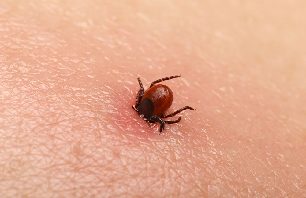 Lyme disease