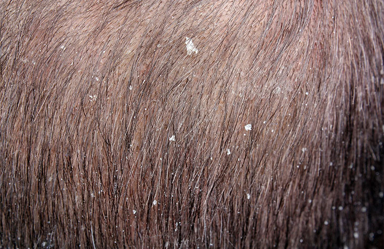 Dry scalp
