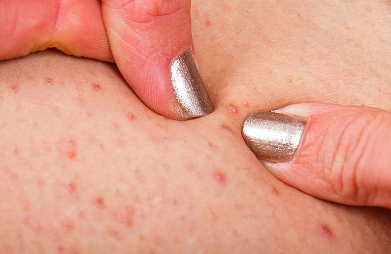 Folliculitis