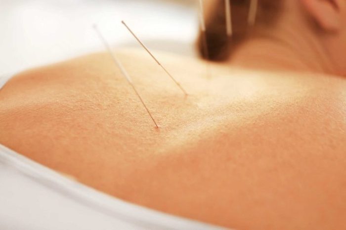 What helps hot flushes: acupuncture