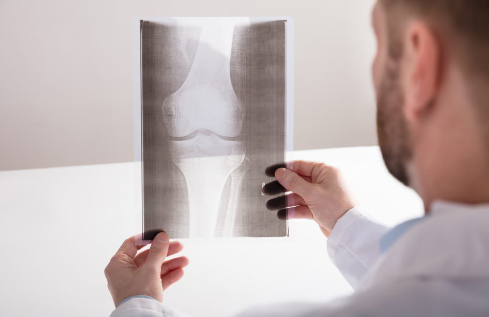 X-rays are still the best diagnostic tool for arthritis