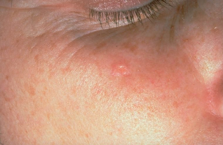 Sebaceous hyperplasia