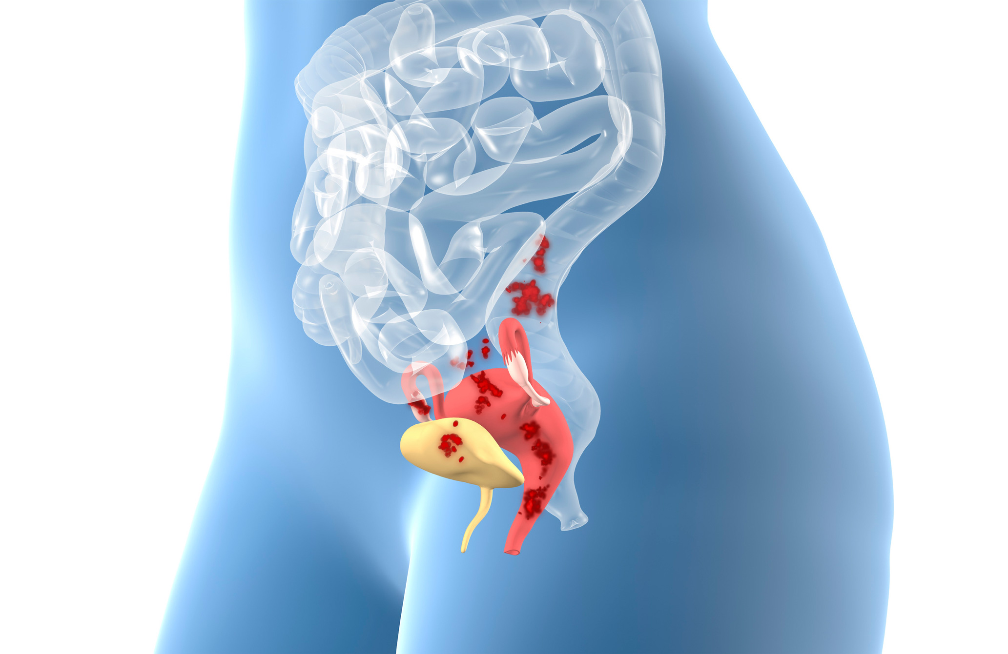 What causes endometriosis?