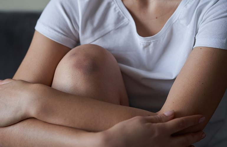 Other reasons you’re bruising easily