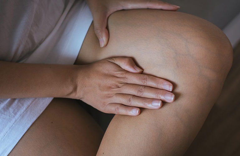 Non-O types: deep vein thrombosis
